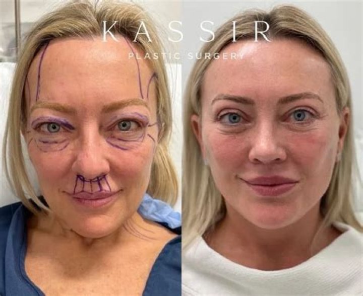 Did Suzanne Rogers Have Plastic Surgery for Face Lift? Illness Explained