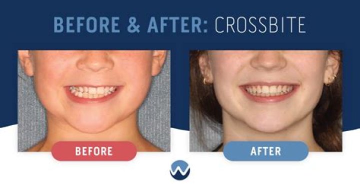 Explore Photos Of Coi Leray Teeth Before And After Braces -Changes Debunked!