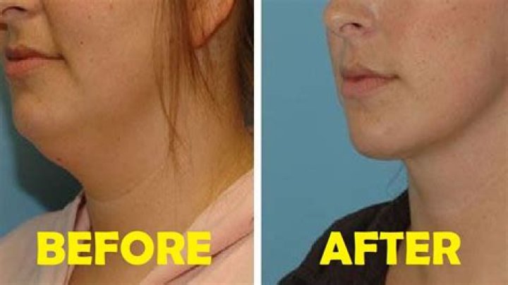 How to get rid of chicken neck