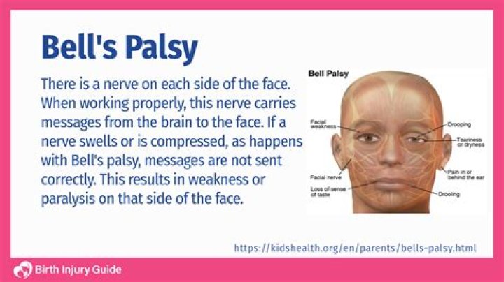Is Carolyn Warmus Still In Jail? Has She Had Face Stroke aka Bell’s Palsy?