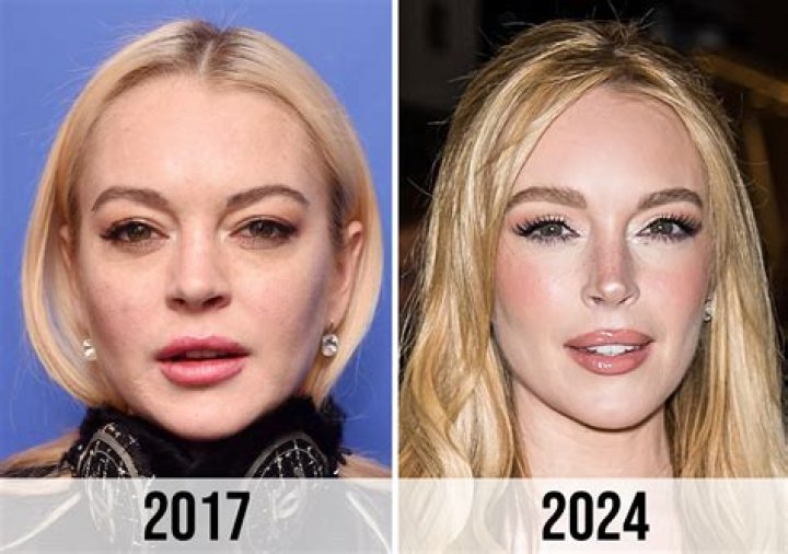 Lindsay Lohan’s Plastic Surgery: Fillers, Nose Job, Eye Lift & More!