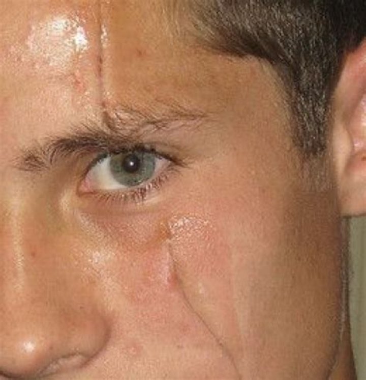 Ryan Clark’s Facial Scar: Injury or Birthmark?