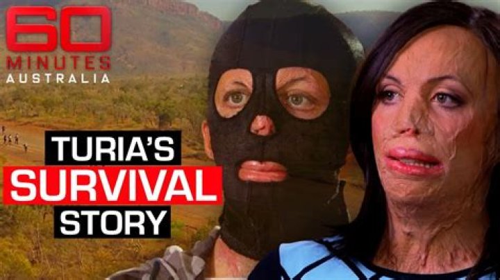 Turia Pitt’s story — Her recovery from 65% burns
