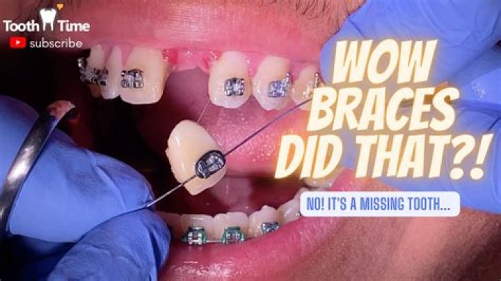 Why Fans Think Joe Locke Is Missing Tooth? Did He Used Braces
