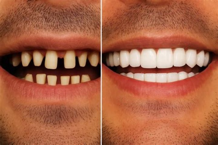 Why Is Rex Ryan Teeth Too White? Did He Use Veneers? Before & After Photos Compared!